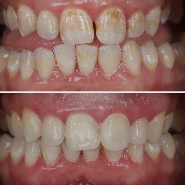 FLUOROSIS